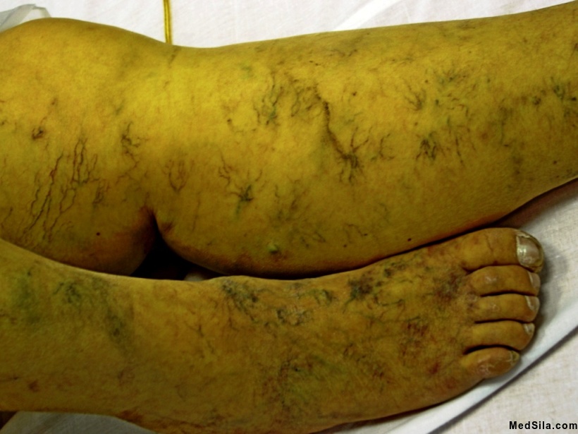 выраженный отек голеней и стоп