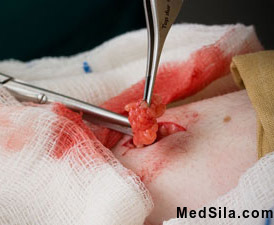 Удаление липомы